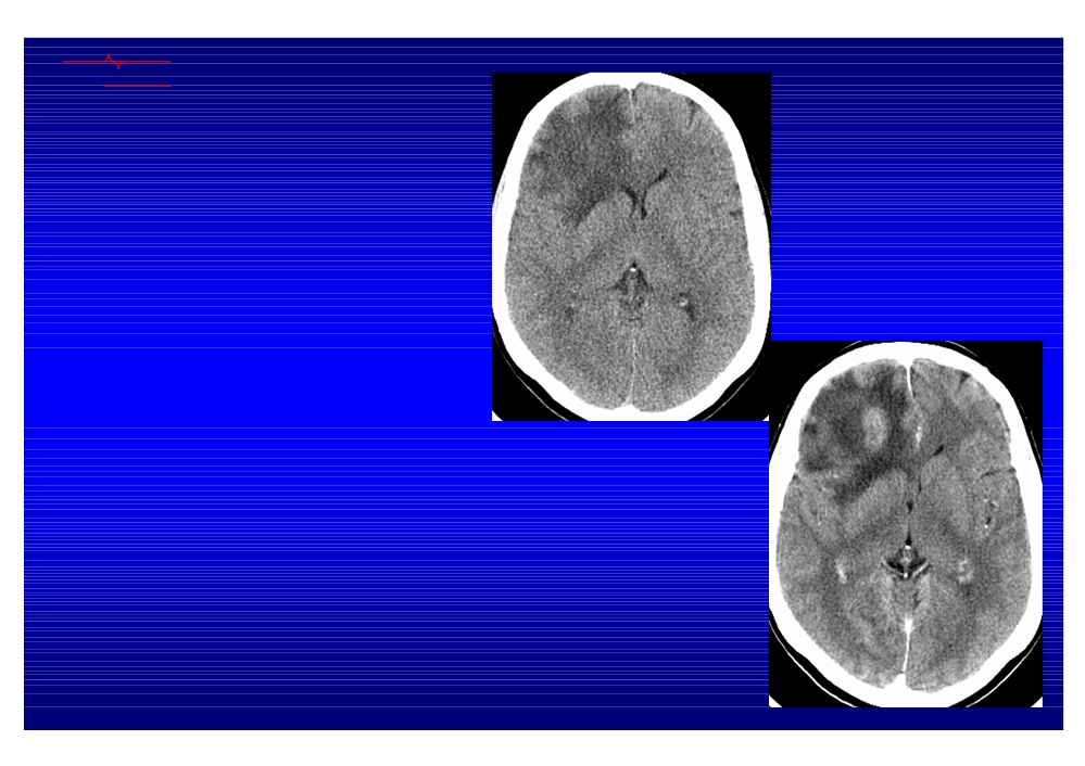 Неоперабельная опухоль головного мозга. Кт картина отека головного мозга. Астроцитома головного мозга кт. Объемное образование головного мозга кт.