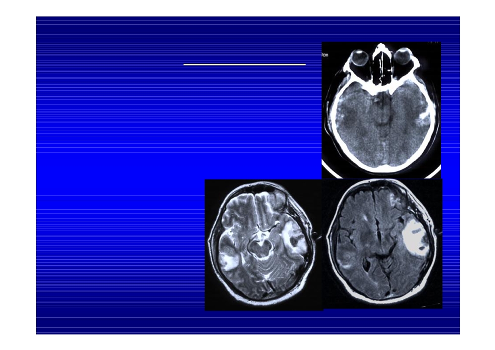 Причины отека головного мозга у взрослых. Вазогенный отек головного мозга кт. Цитотоксический отёк головного мозга кт. Цитотоксический отек мозга на кт. Диагностические критерии отека головного мозга.