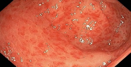 C:\Users\User 1\Pictures\1423088812_poverhnostnyy-gastrit.jpg C:\Users\User 1\Pictures\1423088812_poverhnostnyy-gastrit.jpg