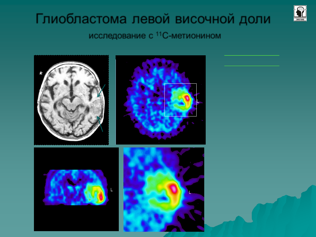 Пэт с тирозином. ПЭТ- позитронно-эмиссионная томография головы. Позитронно-эмиссионная томография. Исследование ЦНС. Позитронно-эмиссионная томография опухоли. ПЭТ кт опухоли головного мозга.