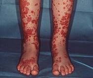 Описание: Описание: http://lechenie-varikoza.com/wp-content/uploads/2014/04/purpura.png