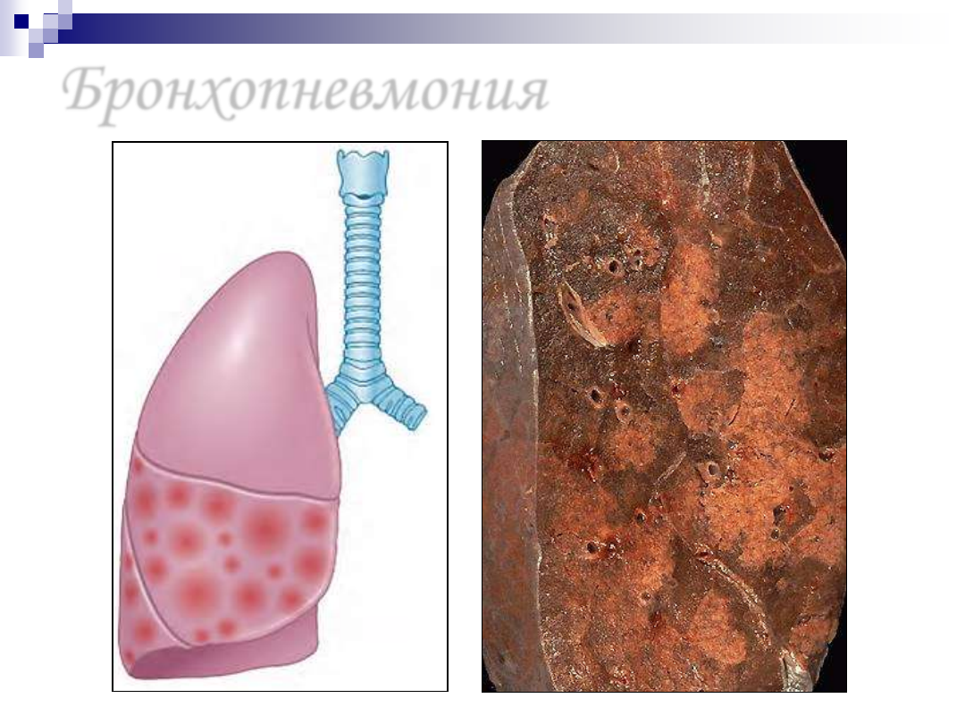 Стафилококковая бронхопневмония. Болезни органов дыхания патанатомия.