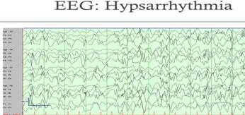 http://slideplayer.com/3883326/13/images/29/EEG%3A+Hypsarrhythmia+American+Epilepsy+Society+2015+PC+Slide-29.jpg