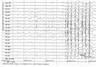 http://epileptologist.ru/img/article/92/6.jpg